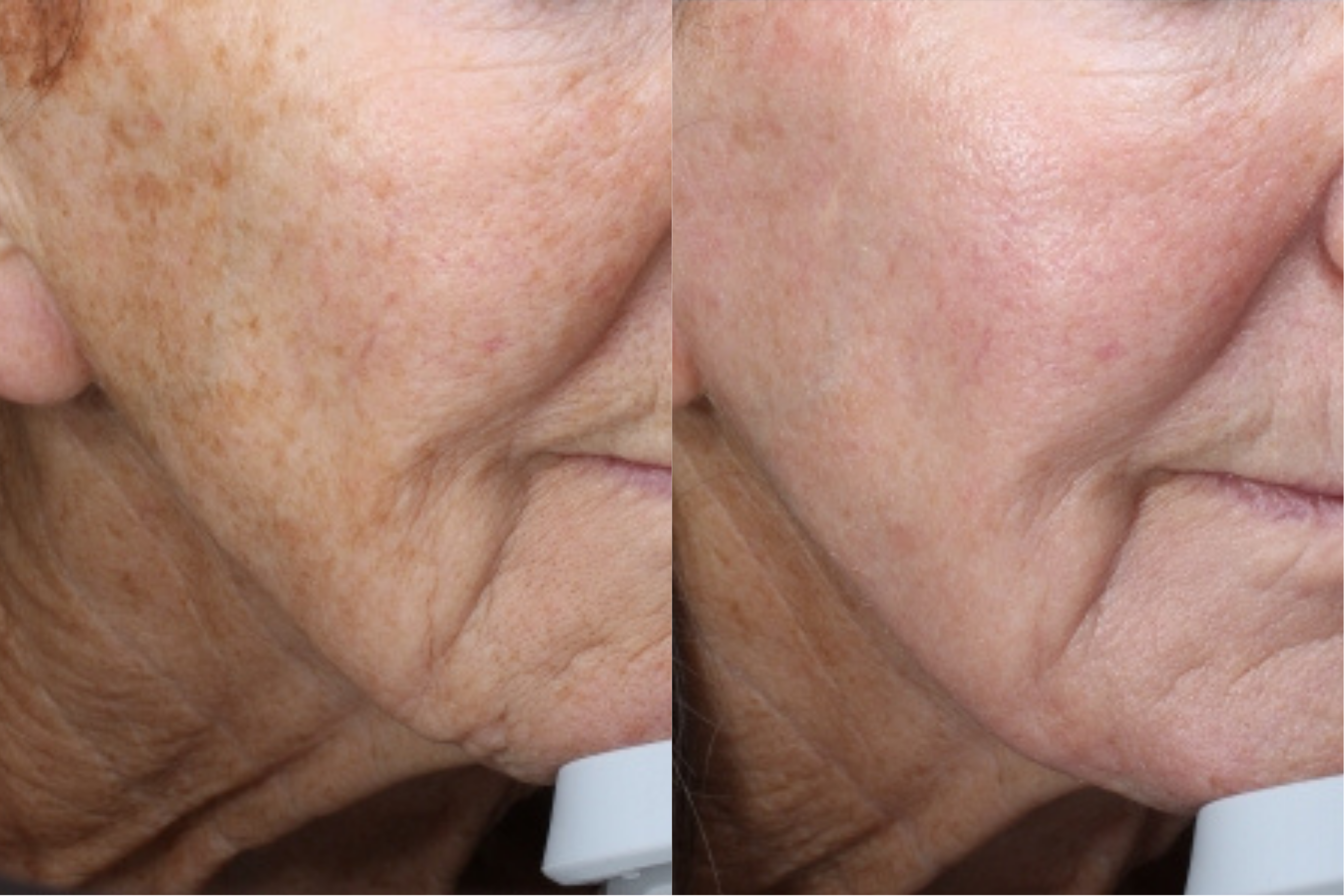 Before and After Result