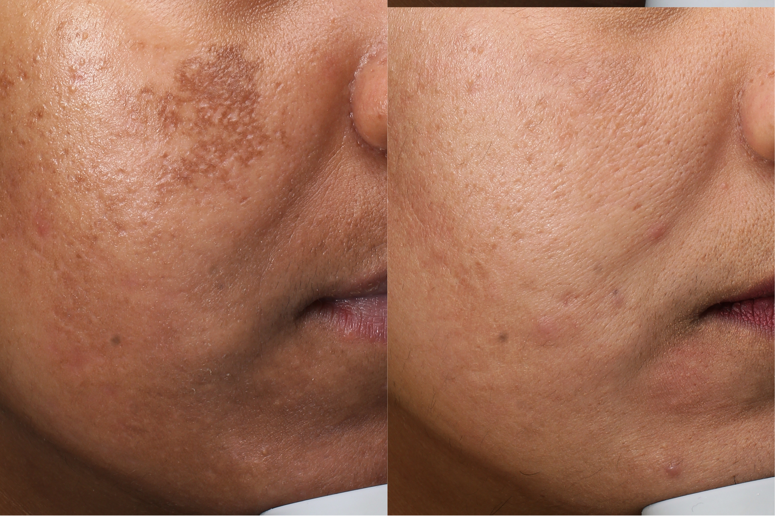 Before and After Result